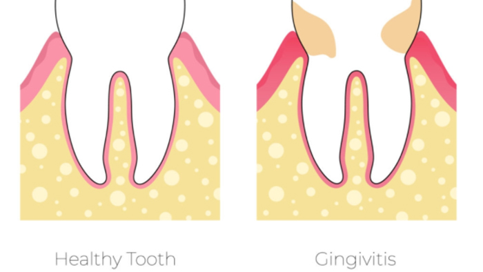 Healthy tooth gingivitis